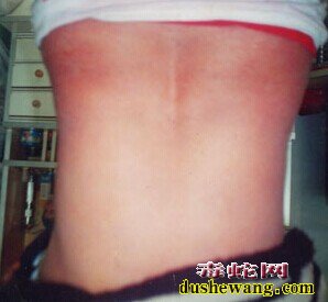 蛇盘疮