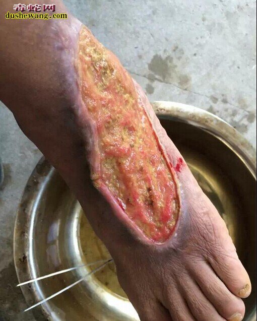 养蛇人必需掌握的技巧,怎样治疗风火毒型蛇伤?