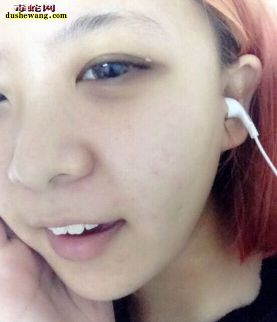 spa蛇毒眼膜怎么样