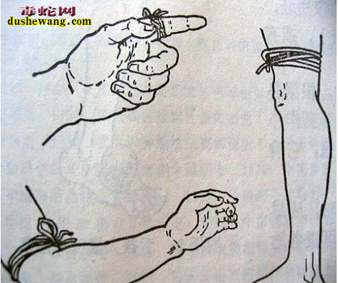 毒蛇咬伤的防治