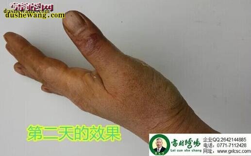雷村蛇场治疗眼镜蛇咬伤全过程