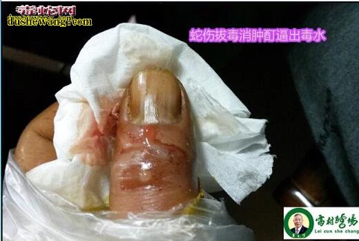 雷村蛇场治疗眼镜蛇咬伤全过程