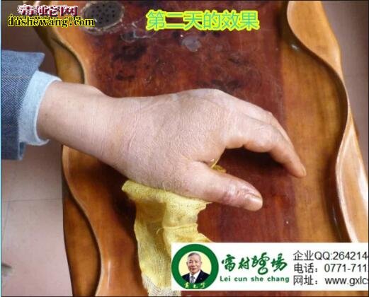 雷村蛇场治疗眼镜蛇咬伤全过程