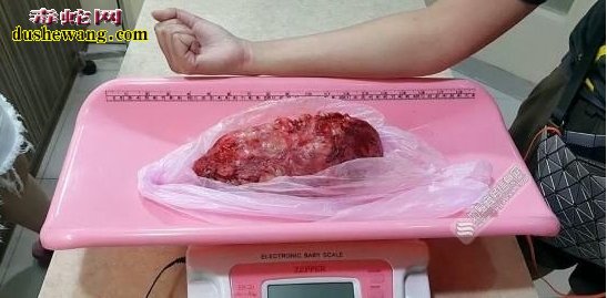 泰国医院给蟒蛇做手术 52公斤蟒蛇体内1公斤肿瘤