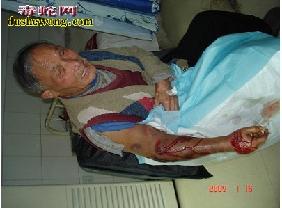 七旬老人毒蛇咬伤自敷药致肾衰 最有效方法注射血清