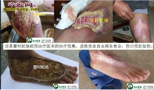 雷村蛇场:揭秘毒蛇咬伤后伤口溃烂植皮治疗的效果