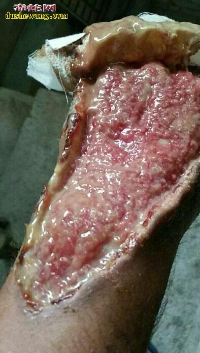 人工养殖毒蛇防蛇与蛇伤医治