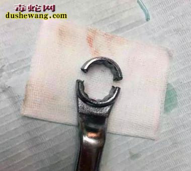 男子下体被扳手套住17小时