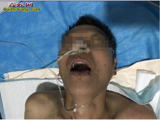 看看黑寡妇蜘蛛有多毒!长沙男子割草昏睡17天!