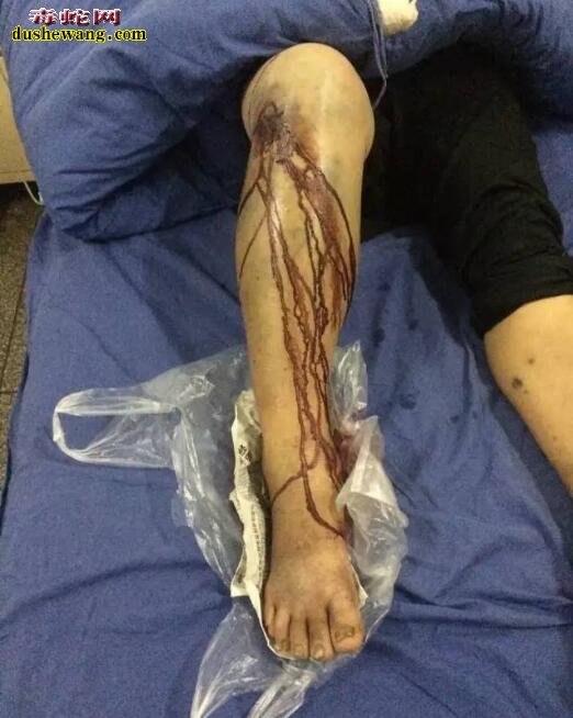 被毒蛇咬伤后,如何紧急处理?