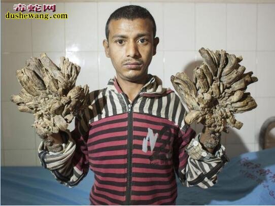“树人”：孟加拉出现“树人”，双手像树皮！怎么回事？