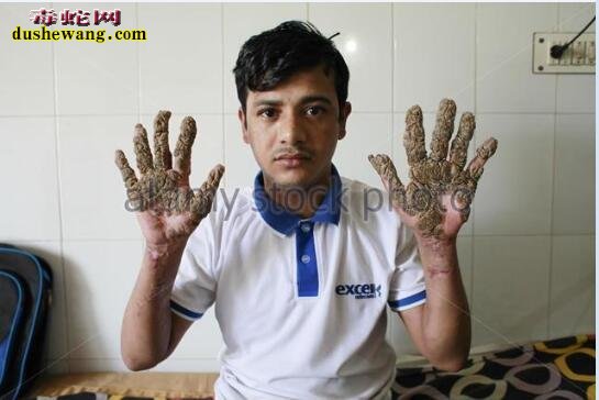 “树人”：孟加拉出现“树人”，双手像树皮！怎么回事？