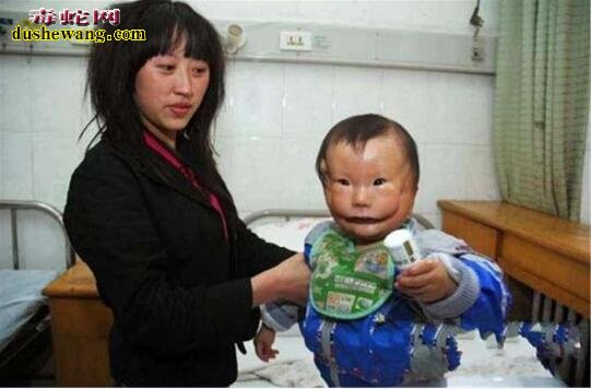 “面具婴儿”23岁女子生下面部断裂像带面具女婴