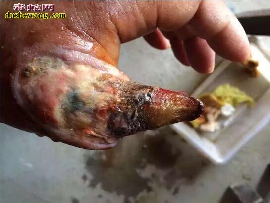 被毒蛇咬伤后对身体有哪些危害?