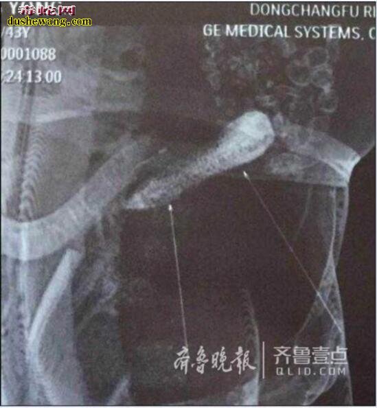 山东聊城大叔15厘米黄瓜卡直肠是怎么回事?