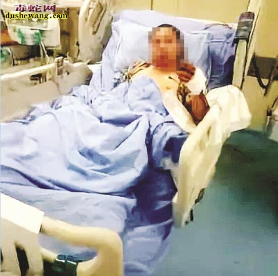 男子好奇看毒蛇被咬伤!医生说手指发黑要截肢保命!