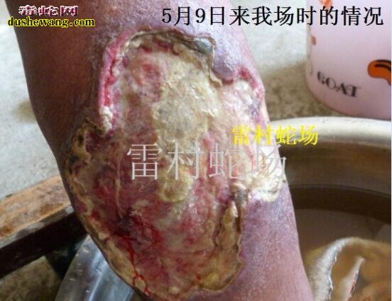 中国十大蛇伤医院