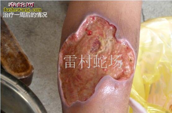 中国十大蛇伤医院
