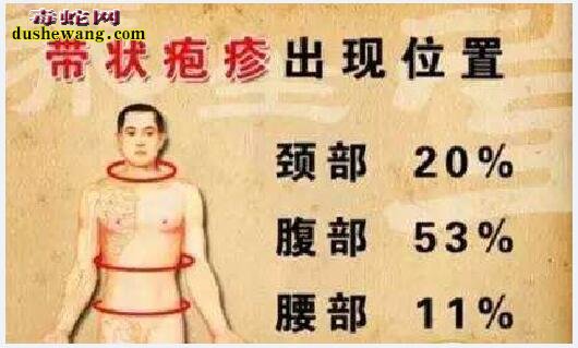 蛇缠身病图片大全、蛇缠身病是什么病?