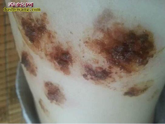 蛇缠身病图片大全、蛇缠身病是什么病?