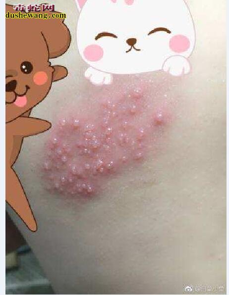 蛇缠身病图片大全、蛇缠身病是什么病?