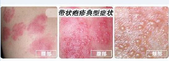 蛇缠身病图片大全、蛇缠身病是什么病?