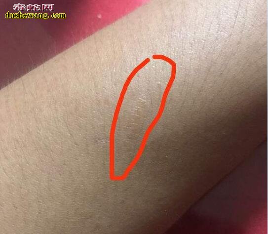 一般蛇咬的伤口牙痕图片大全,看看毒蛇和无毒蛇咬伤不同的伤痕!