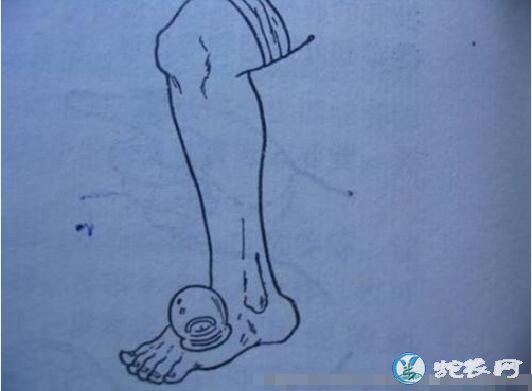如果被眼镜蛇咬伤了怎么办?