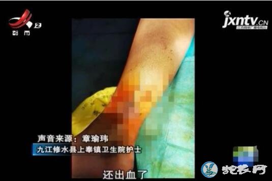 九江护士上晚班被烙铁头蛇咬伤！伤口已经出现坏死！