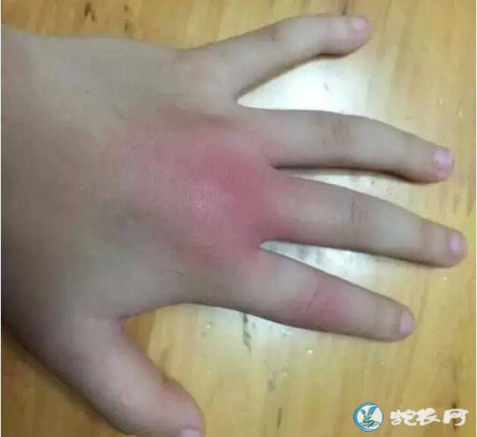 蜈蚣咬了怎么办?如何处理方法?