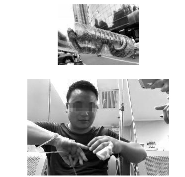 惊吓!男子被毒蛇咬伤!直接带活蛇来医院看病!