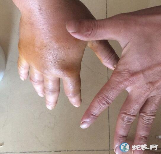 蛇友养殖眼镜蛇被咬案列!无套不抓蛇!做好防护进蛇场是必须的!