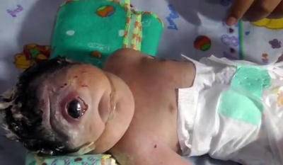 爪哇岛妇女产下“独眼”女婴