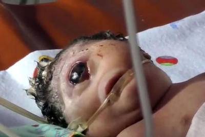 爪哇岛妇女产下“独眼”女婴