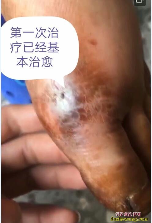 雷村蛇场提醒:被眼镜蛇咬伤后不容忽视的环节-忌口!