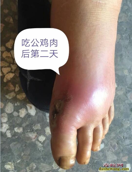 雷村蛇场提醒:被眼镜蛇咬伤后不容忽视的环节-忌口!