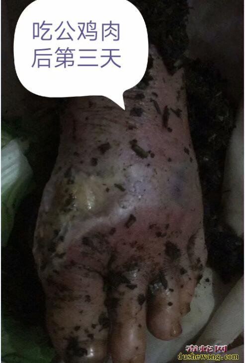 雷村蛇场提醒:被眼镜蛇咬伤后不容忽视的环节-忌口!