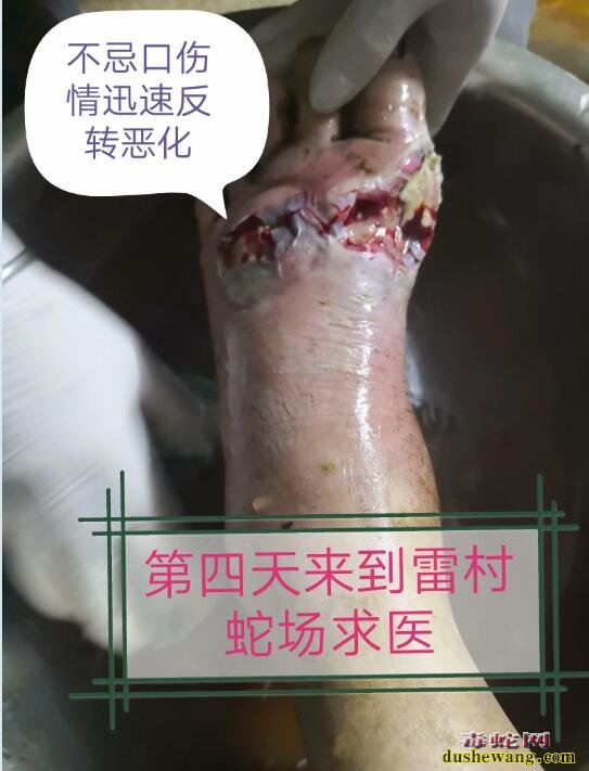 雷村蛇场提醒:被眼镜蛇咬伤后不容忽视的环节-忌口!