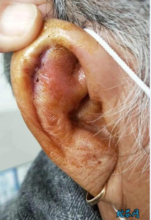 夏季“夺命蜱虫”出没!八旬老太中招!医生警告严重会丢命!