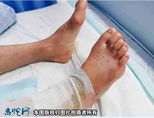 气温回升毒蛇提前出关?泸州2人被毒蛇咬伤住院!