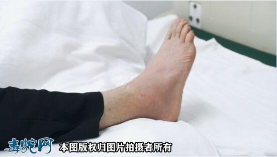 温州一女子被毒蛇咬伤!肇事者为竹叶青咬伤!