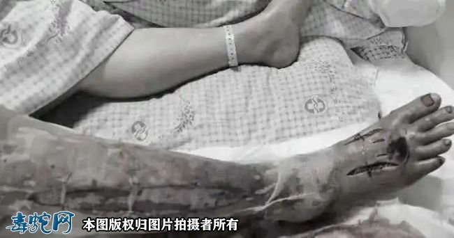 台州女子上山采茶被剧毒五步蛇咬伤!看到受伤的腿就哆嗦!