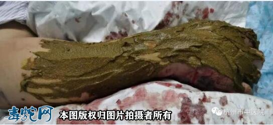 杭州男子抓五步蛇泡药酒被咬伤