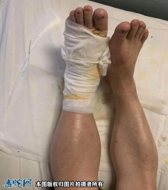 宁波台风过后毒蛇出没伤人!浙江已有人被咬伤!