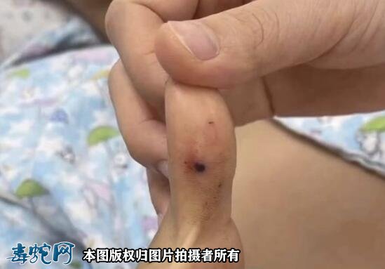 广西9岁小男孩被毒蛇咬伤住进ICU！医生判断是红脖颈槽蛇！