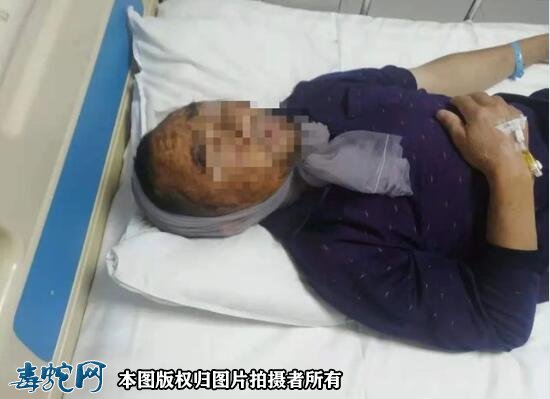 松桃县一村民头部被毒蛇咬伤!