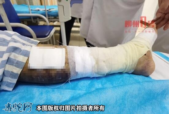 柳州多起毒蛇咬伤!电动车碾过毒蛇被反咬昏迷两天!