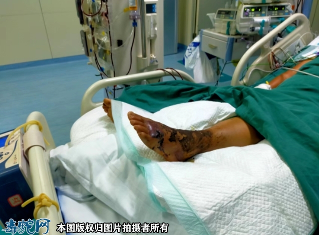 阜阳大娘被毒蛇“咬”进ICU 毒蛇咬...