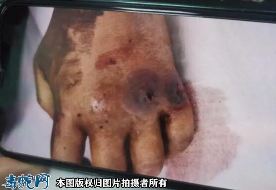 毒蛇咬了都是两个伤口吗？