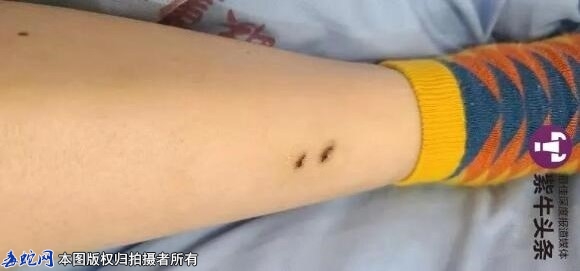 女子云南旅游入住酒店被银环蛇咬伤捡回...